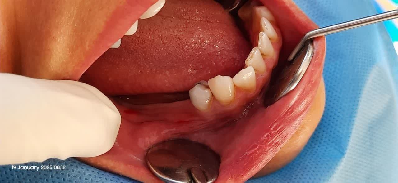 ايمپلنت ديجيتال