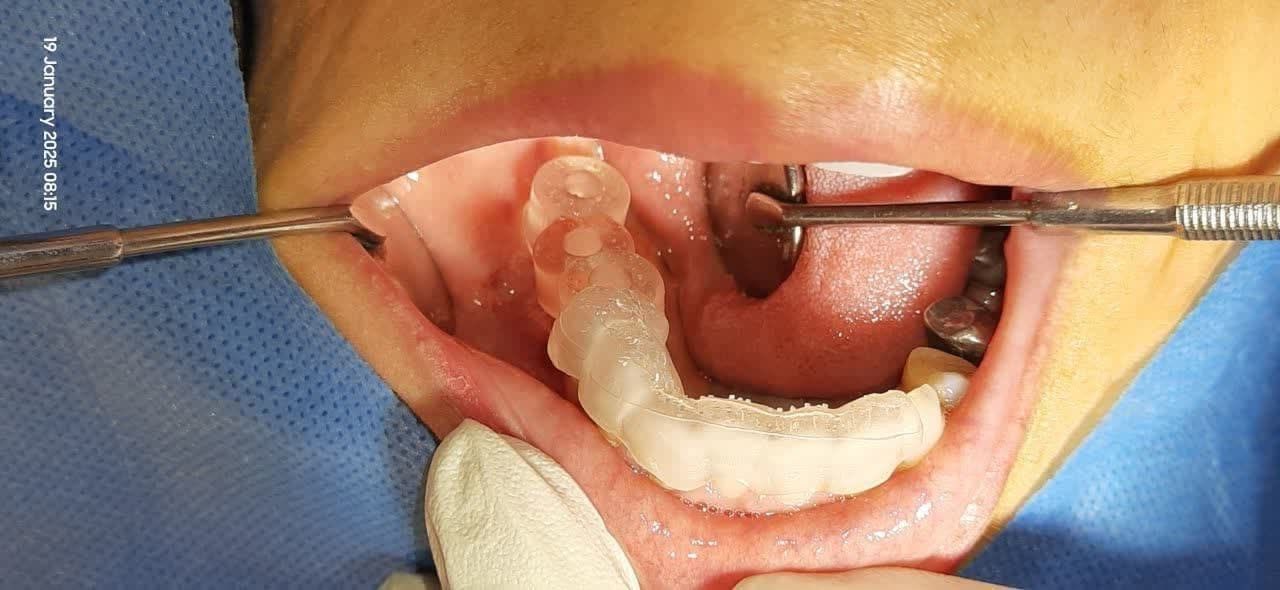 ايمپلنت ديجيتال