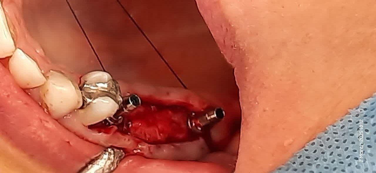 ايمپلنت ديجيتال