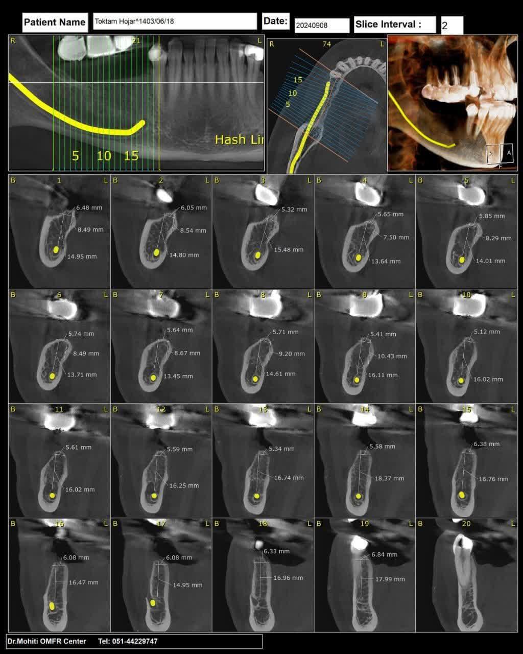 ايمپلنت ديجيتال