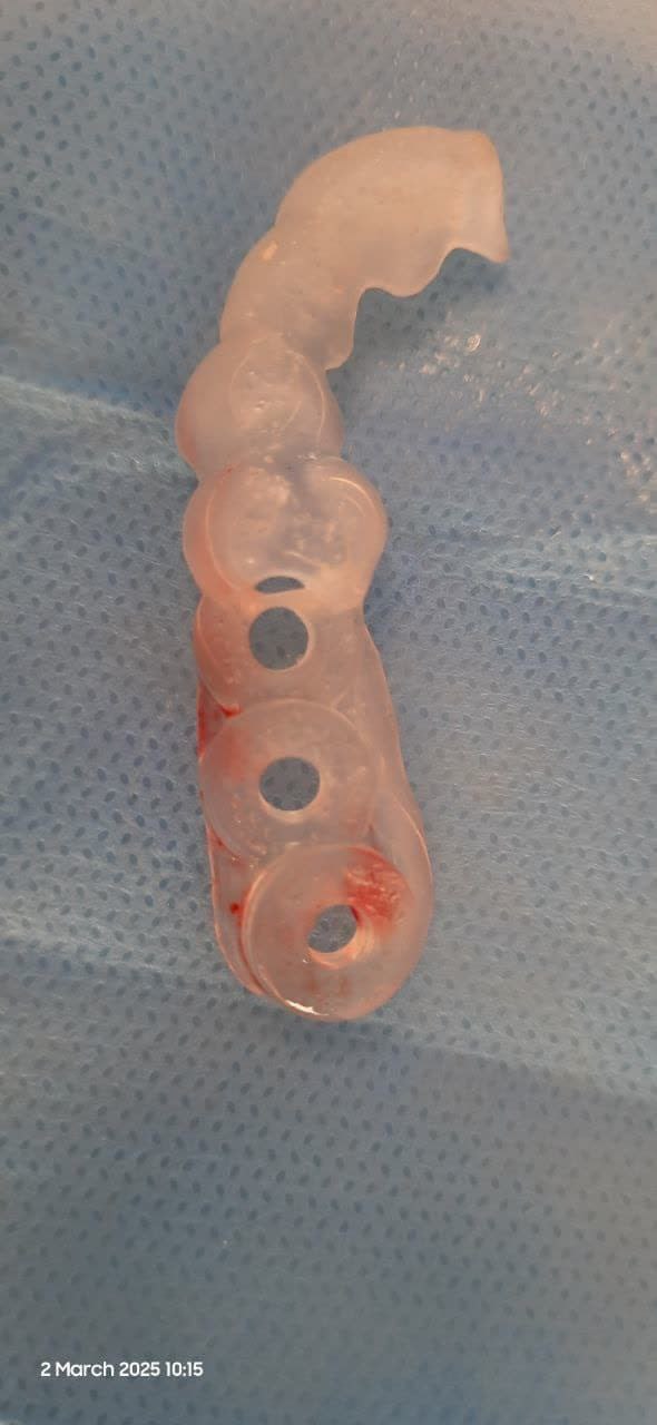 ايمپلنت ديجيتال