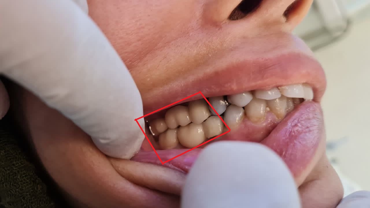 ايمپلنت ديجيتال